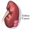 Cancer Images